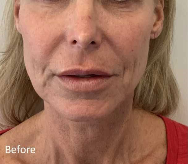 PDO Thread Lift Before and After | Summit Aesthetics