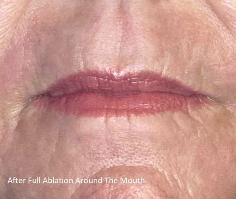 Perioral Facial Resurfacing Before and After | Summit Aesthetics