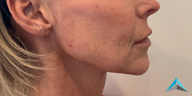 Dermal Fillers Botox Before and After | Summit Aesthetics
