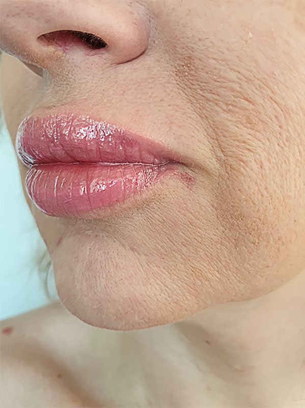 Sciton Laser Resurfacing Before and After | Summit Aesthetics