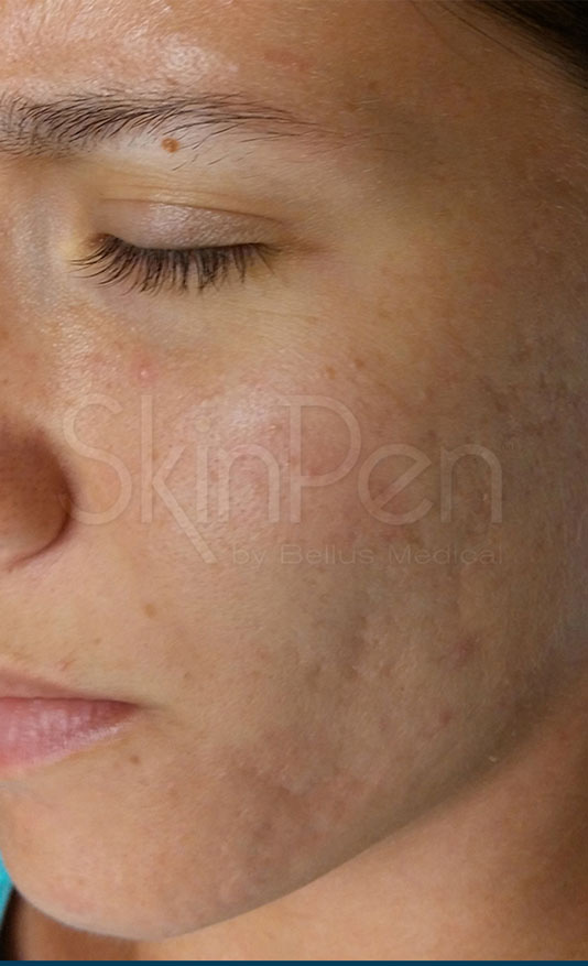 After microneedling in North Scottsdale at Summit Aesthetics