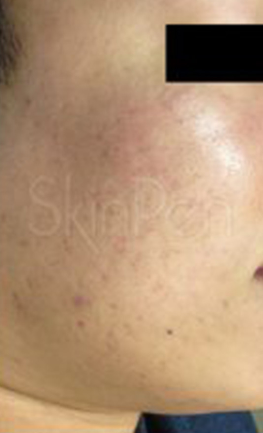 After microneedling in Cave Creek at Summit Aesthetics